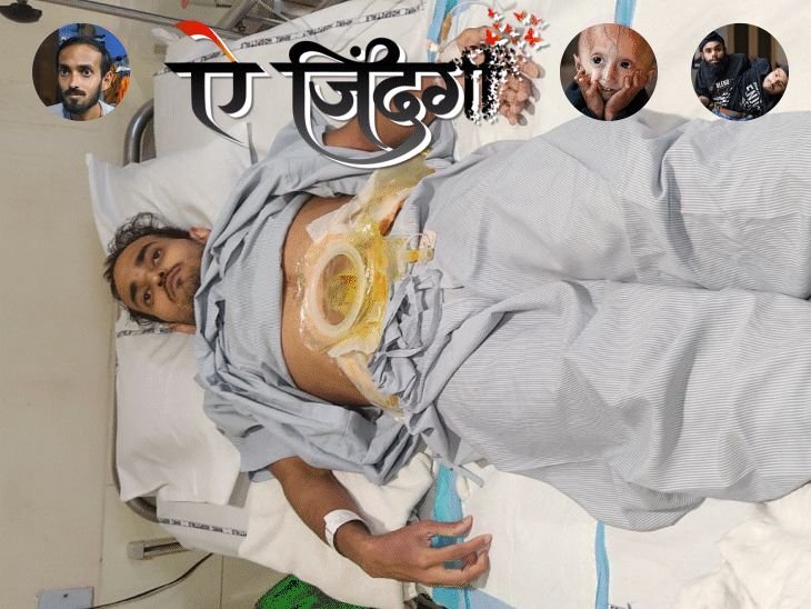 लग्नाच्या दिवशी आतडी फाटली, 5 महिने पोट उघडे राहिले:सूप पिले, तर छातीतून बाहेर पडले, हनिमूनलाही जाता आले नाही